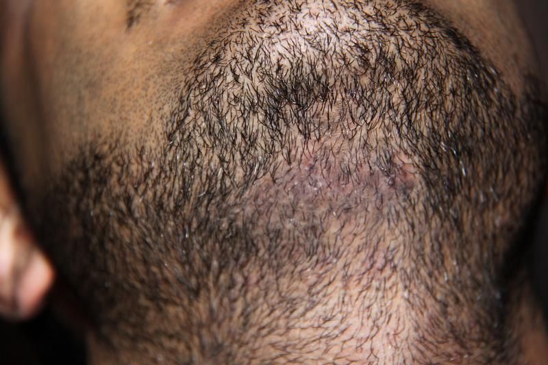 Beard to Beard 150 FUE Scar Repair 0-5 Months BHR Clinic | Hair loss